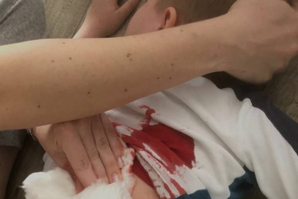 Кричал: я тебя убью. В Новоселье 6-летний мальчик получил удар секатором в спину от сверстника