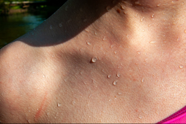 Не аллергия или дерматит: Врач объяснил, откуда берутся красные высыпания на коже